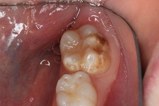 Kreidezähne (Foto: Dr. Norbert Krämer) Kreidezähne (Foto: Dr. Norbert Krämer)